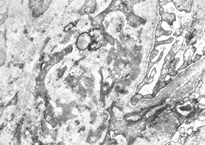 F,15y. | IgA nephropathy … subendothelial deposits F,15y. | IgA nephropathy … subendothelial deposits